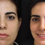 Acne Scar Removal - New Age Methods For Clear Skin