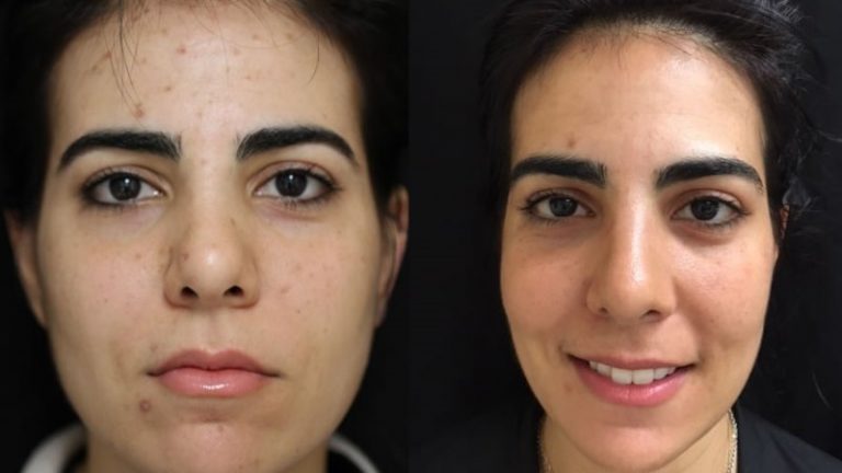 Acne Scar Removal - New Age Methods For Clear Skin