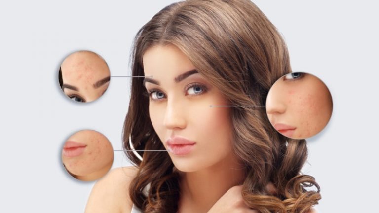 8 Tips On How To Remove Chickenpox Scars