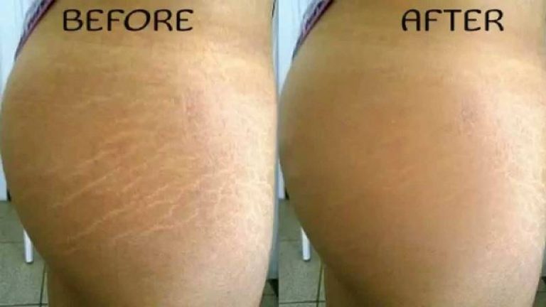 Do Stretch Marks Ever Really Disappear?