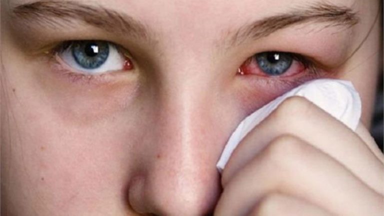 Pink Eye Symptoms