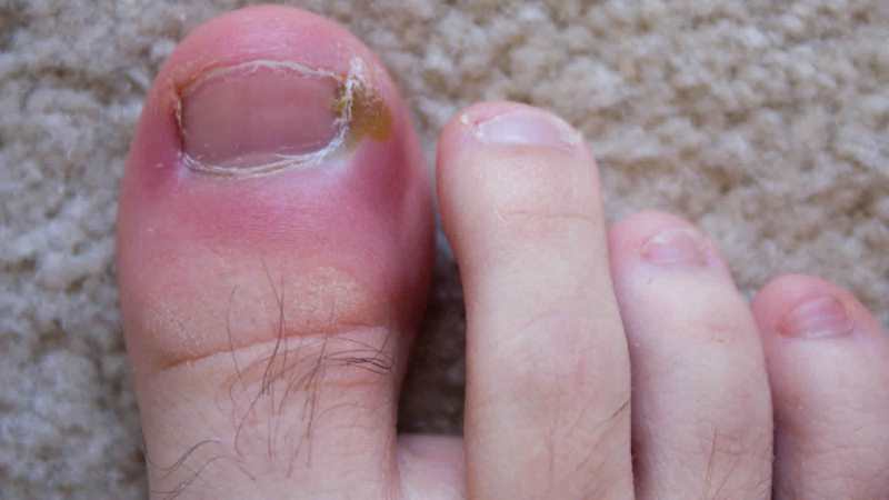 Paronychia (Nail Disorder) - Causes, Symptoms And Treatment