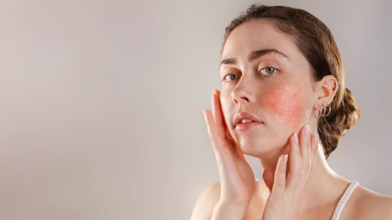 Rosacea - Treatment and Solutions