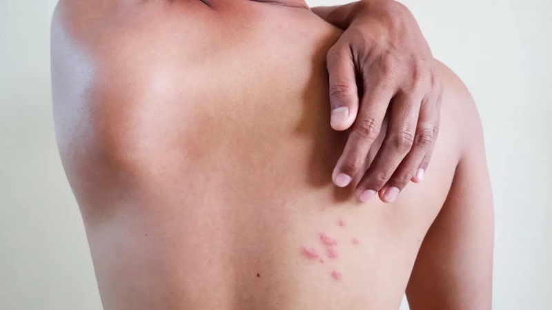 Shingles - Causes, Symptoms and Treatment