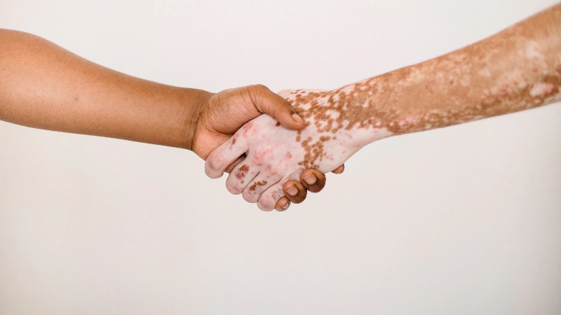 Vitiligo - Causes, Symptoms and Treatment